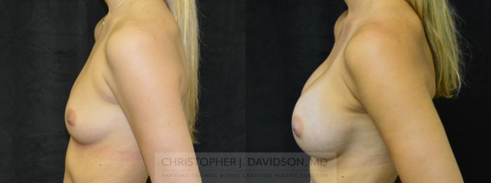 Breast Augmentation Case 39 Before & After View #3 | Boston, MA | Christopher J. Davidson, MD