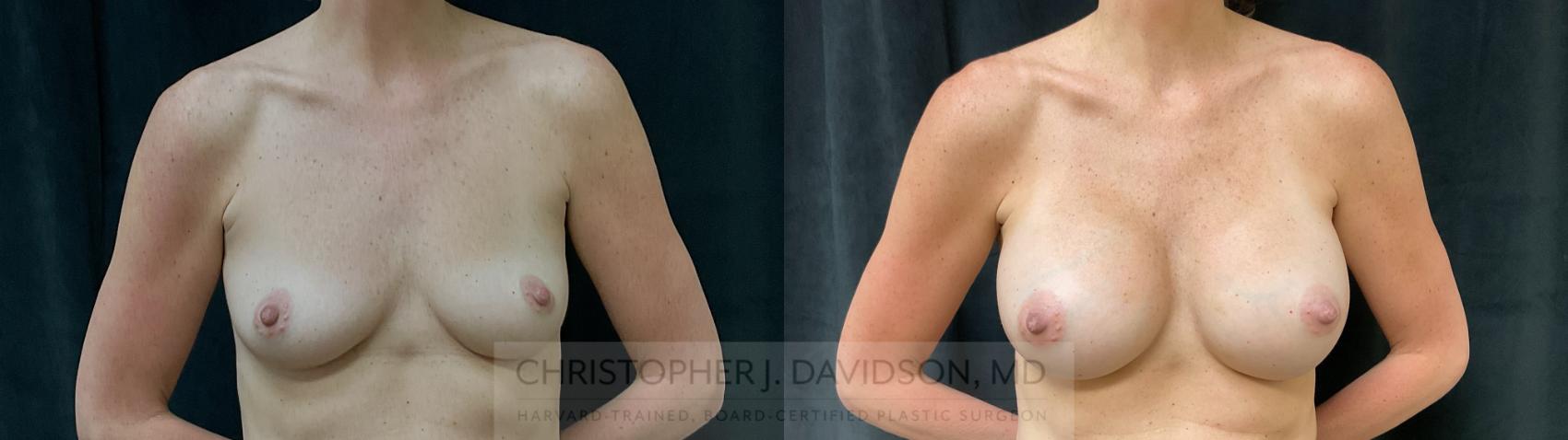 Breast Augmentation Case 393 Before & After Front | Boston, MA | Christopher J. Davidson, MD