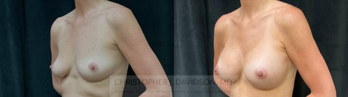 Breast Augmentation Case 393 Before & After Left Oblique | Boston, MA | Christopher J. Davidson, MD