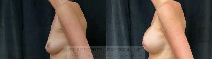 Breast Augmentation Case 393 Before & After Left Side | Boston, MA | Christopher J. Davidson, MD