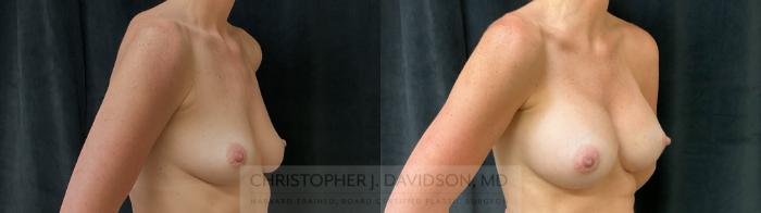 Breast Augmentation Case 393 Before & After Right Oblique | Boston, MA | Christopher J. Davidson, MD