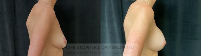 Breast Augmentation Case 393 Before & After Right Side | Boston, MA | Christopher J. Davidson, MD