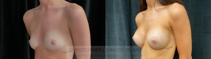 Breast Augmentation Case 394 Before & After Left Oblique | Boston, MA | Christopher J. Davidson, MD