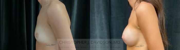 Breast Augmentation Case 394 Before & After Left Side | Boston, MA | Christopher J. Davidson, MD