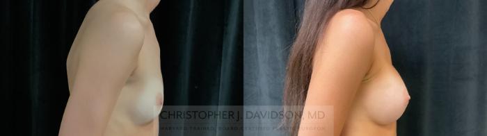 Breast Augmentation Case 394 Before & After Right Side | Boston, MA | Christopher J. Davidson, MD