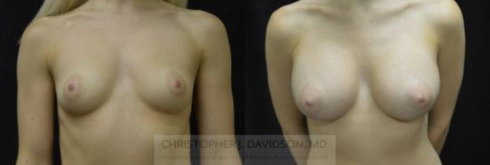 Breast Augmentation Case 4 Before & After View #1 | Boston, MA | Christopher J. Davidson, MD