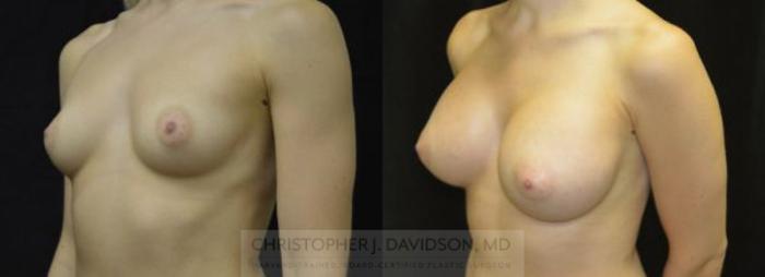 Breast Augmentation Case 4 Before & After View #2 | Boston, MA | Christopher J. Davidson, MD