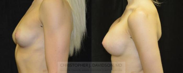 Breast Augmentation Case 4 Before & After View #3 | Boston, MA | Christopher J. Davidson, MD