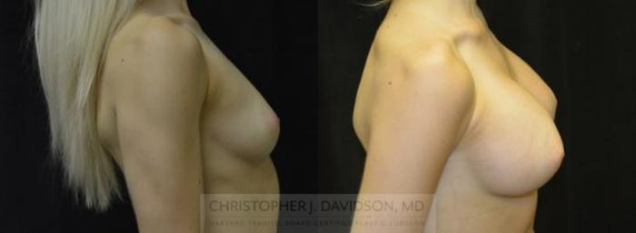 Breast Augmentation Case 4 Before & After View #4 | Boston, MA | Christopher J. Davidson, MD