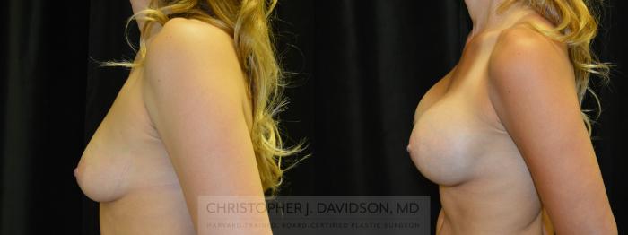 Breast Augmentation Case 406 Before & After Left Side | Boston, MA | Christopher J. Davidson, MD