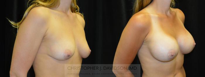 Breast Augmentation Case 406 Before & After Right Oblique | Boston, MA | Christopher J. Davidson, MD