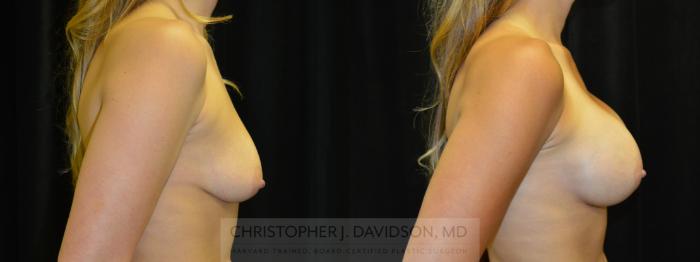 Breast Augmentation Case 406 Before & After Right Side | Boston, MA | Christopher J. Davidson, MD