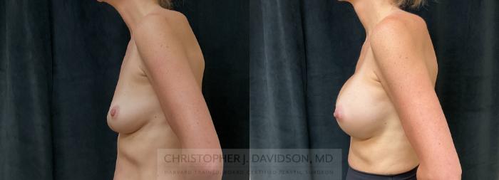 Breast Augmentation Case 415 Before & After Left Side | Boston, MA | Christopher J. Davidson, MD