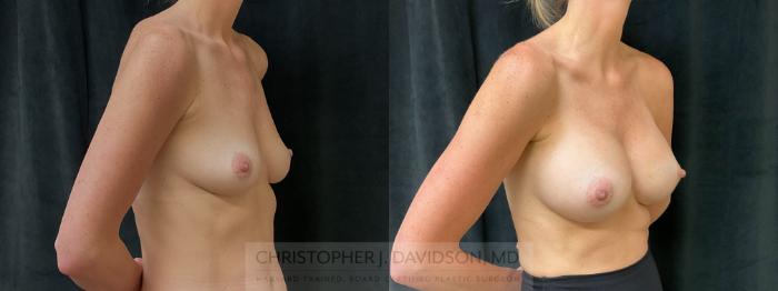 Breast Augmentation Case 415 Before & After Right Oblique | Boston, MA | Christopher J. Davidson, MD