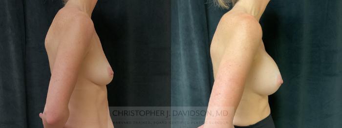 Breast Augmentation Case 415 Before & After Right Side | Boston, MA | Christopher J. Davidson, MD