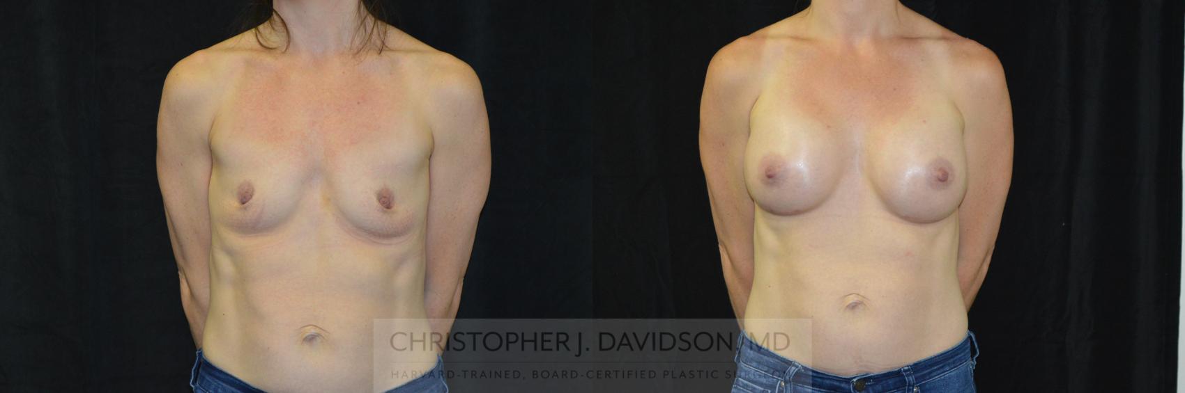 Breast Augmentation Case 417 Before & After Front | Boston, MA | Christopher J. Davidson, MD