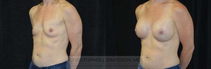 Breast Augmentation Case 417 Before & After Left Oblique | Boston, MA | Christopher J. Davidson, MD