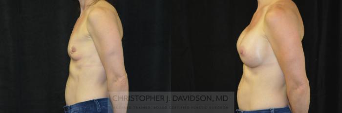 Breast Augmentation Case 417 Before & After Left Side | Boston, MA | Christopher J. Davidson, MD