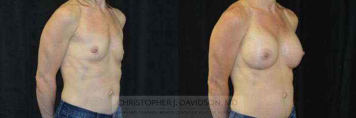 Breast Augmentation Case 417 Before & After Right Oblique | Boston, MA | Christopher J. Davidson, MD