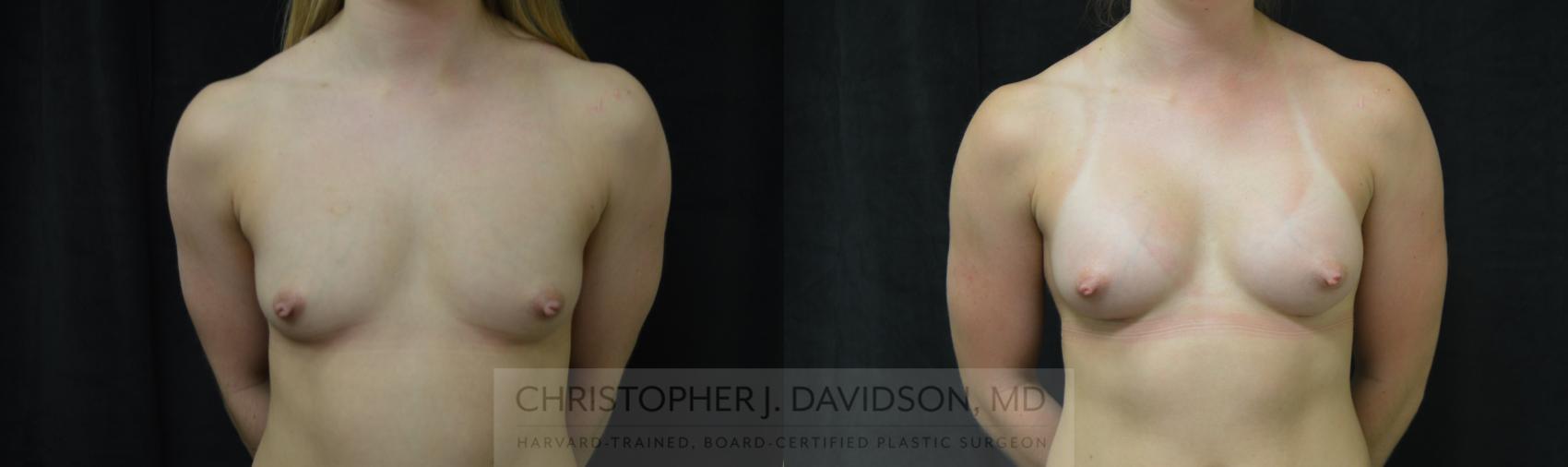 Breast Augmentation Case 418 Before & After Front | Boston, MA | Christopher J. Davidson, MD