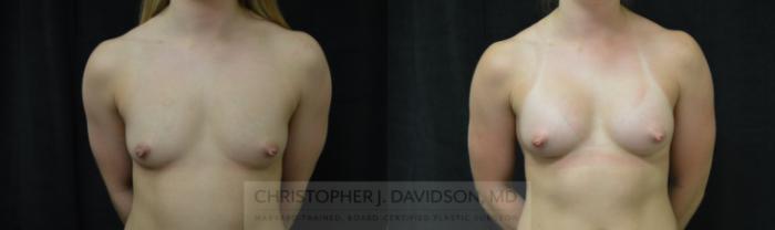 Breast Augmentation Case 418 Before & After Front | Boston, MA | Christopher J. Davidson, MD