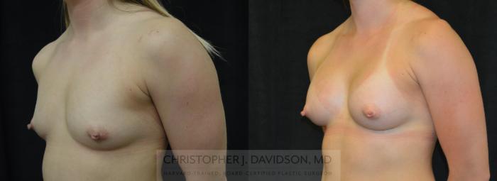 Breast Augmentation Case 418 Before & After Left Oblique | Boston, MA | Christopher J. Davidson, MD