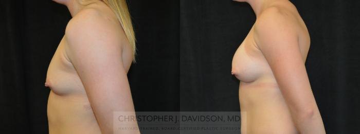 Breast Augmentation Case 418 Before & After Left Side | Boston, MA | Christopher J. Davidson, MD