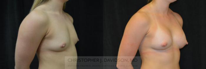 Breast Augmentation Case 418 Before & After Right Oblique | Boston, MA | Christopher J. Davidson, MD
