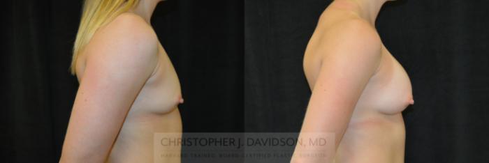 Breast Augmentation Case 418 Before & After Right Side | Boston, MA | Christopher J. Davidson, MD