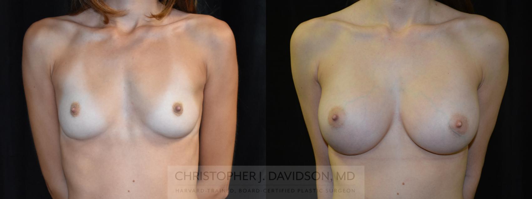 Breast Augmentation Case 420 Before & After Front | Boston, MA | Christopher J. Davidson, MD