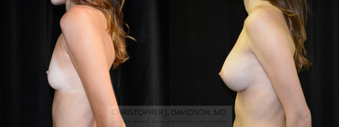 Breast Augmentation Case 420 Before & After Left Side | Boston, MA | Christopher J. Davidson, MD