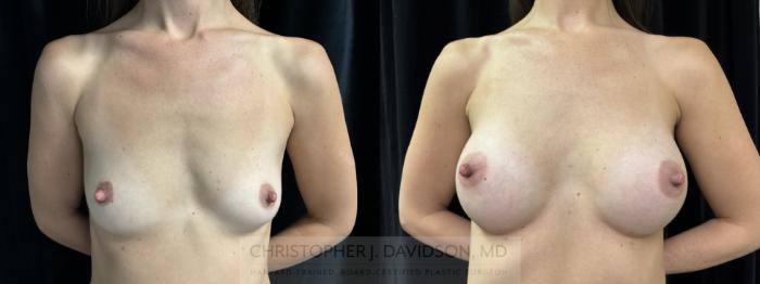 Breast Augmentation Case 437 Before & After Front | Boston, MA | Christopher J. Davidson, MD