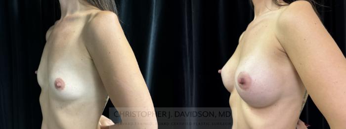 Breast Augmentation Case 437 Before & After Left Oblique | Boston, MA | Christopher J. Davidson, MD