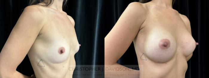 Breast Augmentation Case 437 Before & After Right Oblique | Boston, MA | Christopher J. Davidson, MD