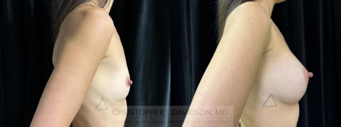 Breast Augmentation Case 437 Before & After Right Side | Boston, MA | Christopher J. Davidson, MD