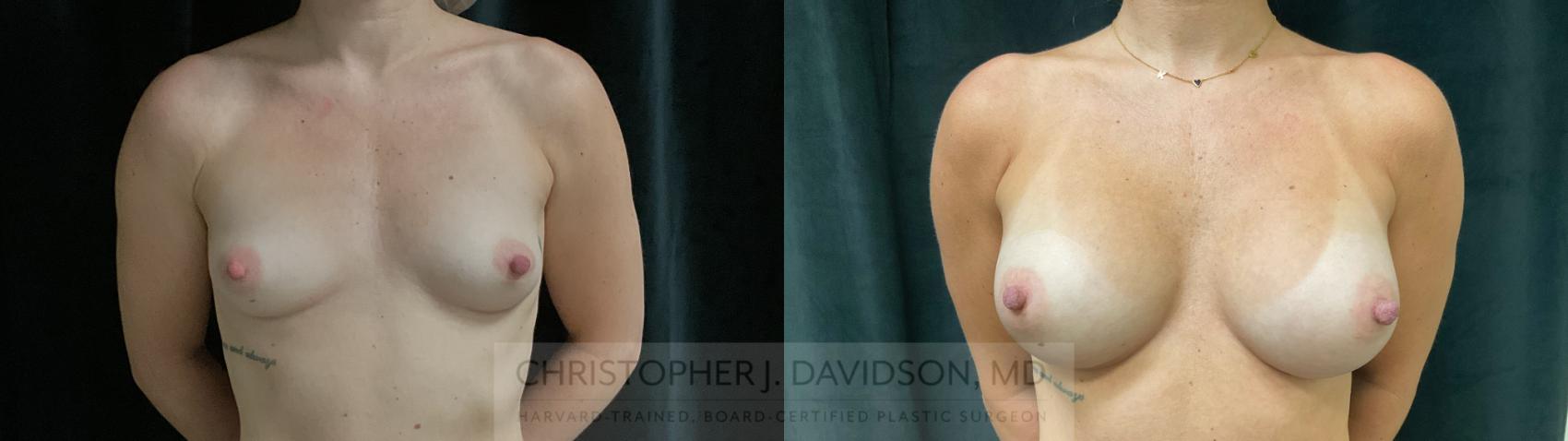 Breast Augmentation Case 438 Before & After Front | Boston, MA | Christopher J. Davidson, MD