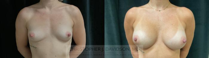 Breast Augmentation Case 438 Before & After Front | Boston, MA | Christopher J. Davidson, MD