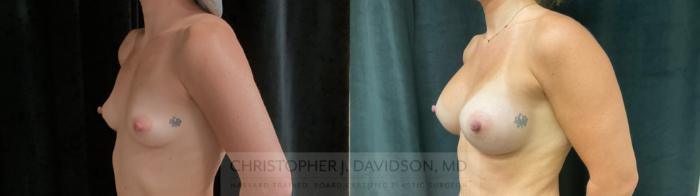 Breast Augmentation Case 438 Before & After Left Oblique | Boston, MA | Christopher J. Davidson, MD
