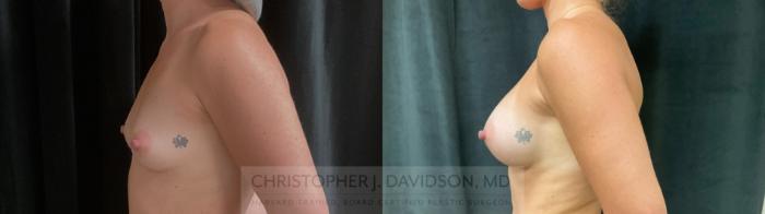 Breast Augmentation Case 438 Before & After Left Side | Boston, MA | Christopher J. Davidson, MD