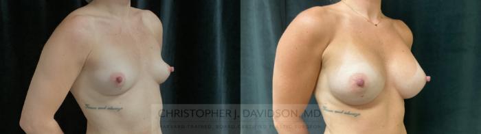 Breast Augmentation Case 438 Before & After Right Oblique | Boston, MA | Christopher J. Davidson, MD