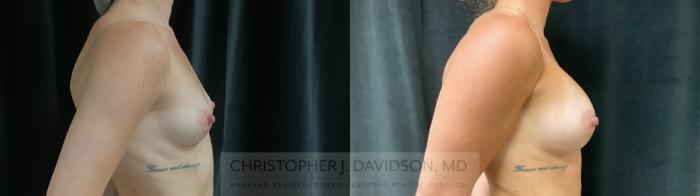 Breast Augmentation Case 438 Before & After Right Side | Boston, MA | Christopher J. Davidson, MD