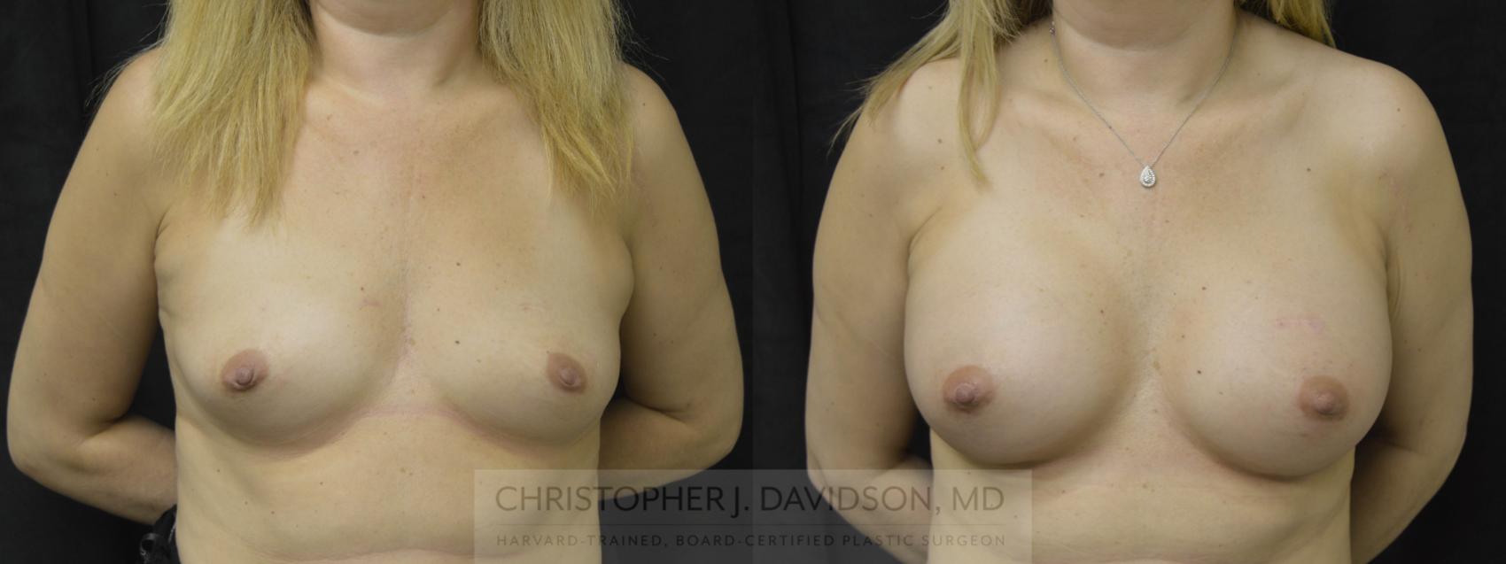 Breast Augmentation Case 44 Before & After View #1 | Boston, MA | Christopher J. Davidson, MD