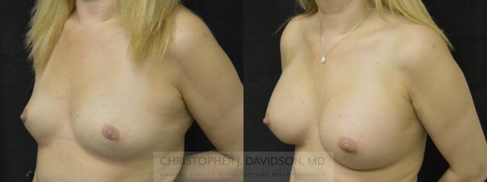Breast Augmentation Case 44 Before & After View #3 | Boston, MA | Christopher J. Davidson, MD