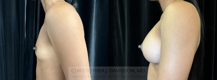 Breast Augmentation Case 441 Before & After Left Side | Boston, MA | Christopher J. Davidson, MD