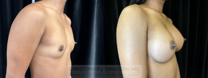 Breast Augmentation Case 441 Before & After Right Oblique | Boston, MA | Christopher J. Davidson, MD