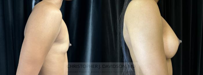 Breast Augmentation Case 441 Before & After Right Side | Boston, MA | Christopher J. Davidson, MD