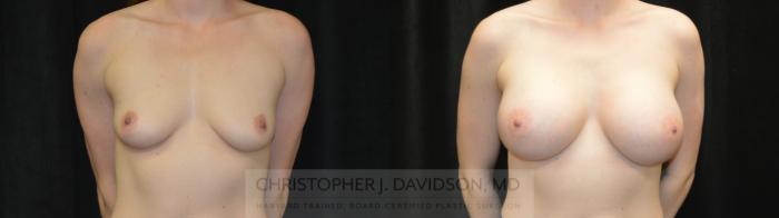 Breast Augmentation Case 445 Before & After Front | Boston, MA | Christopher J. Davidson, MD