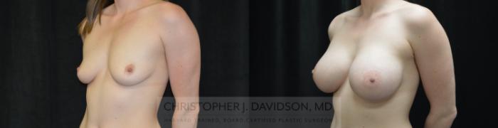 Breast Augmentation Case 445 Before & After Left Oblique | Boston, MA | Christopher J. Davidson, MD