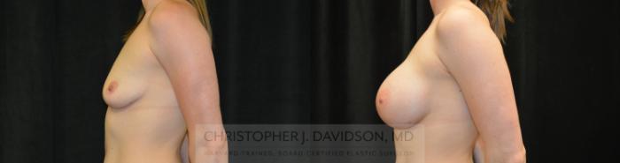 Breast Augmentation Case 445 Before & After Left Side | Boston, MA | Christopher J. Davidson, MD