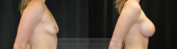 Breast Augmentation Case 445 Before & After Right Side | Boston, MA | Christopher J. Davidson, MD